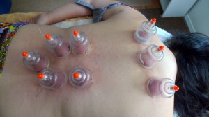 Korean style Cupping Therapy with Dry Needling for Low Back and Upper Back Pain with Eyton Shalom, L.Ac. San Diego Acupuncturist